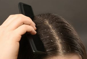 খুশকি কেন হয় এবং কিভাবে নিয়ন্ত্রণে রাখবেন? জেনে নিন কার্যকর পরামর্শ