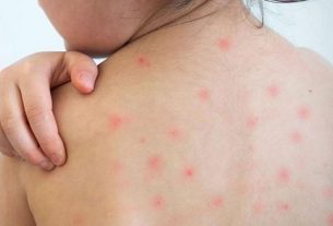 দেশজুড়ে হা'মে'র প্রকোপ বেড়ে আতঙ্ক, ১৯ দিনে মৃ'ত্যু ৯৪